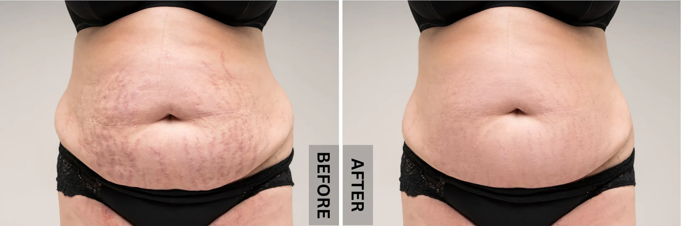 before and after using red light therapy belt from rlb
