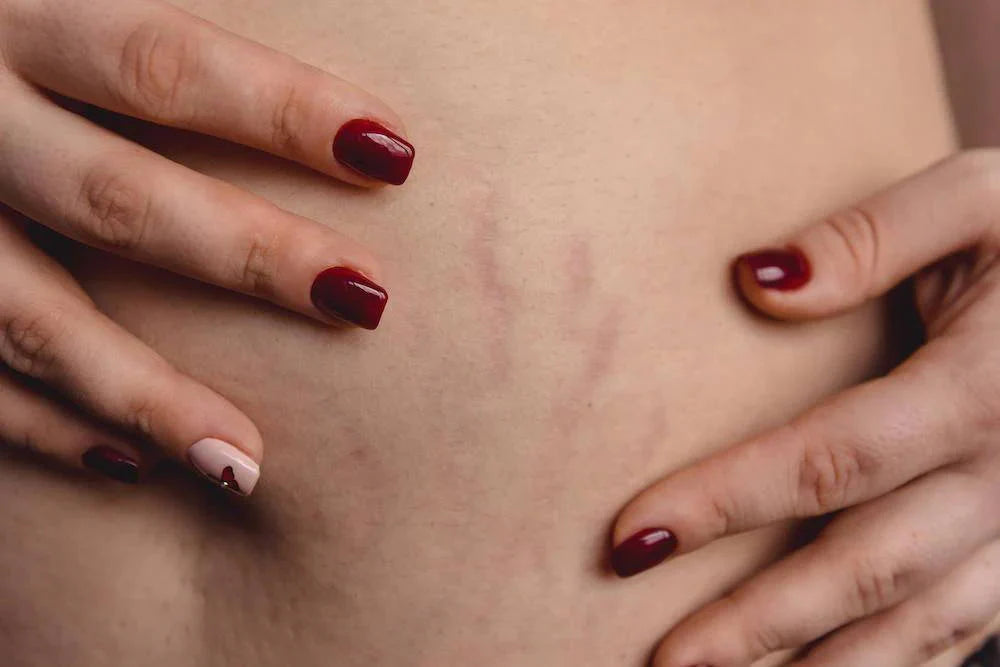 Is Red Light Therapy Safe During Pregnancy?