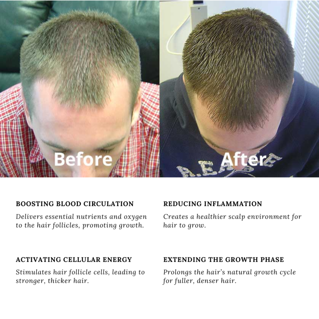 Before and after comparison showcasing hair growth improvement using the RLB LED Mask &amp; Laser Hair Growth System, highlighting benefits such as boosted blood circulation, reduced inflammation, activated cellular energy, and extended growth phase for healthier hair.