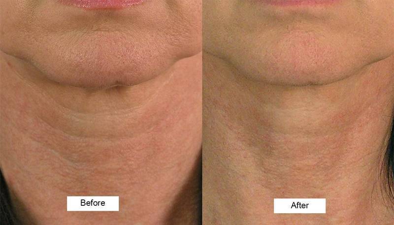 Close-up before and after photos showing dramatic neck skin tightening and reduction of sagging skin achieved with a microcurrent beauty device.