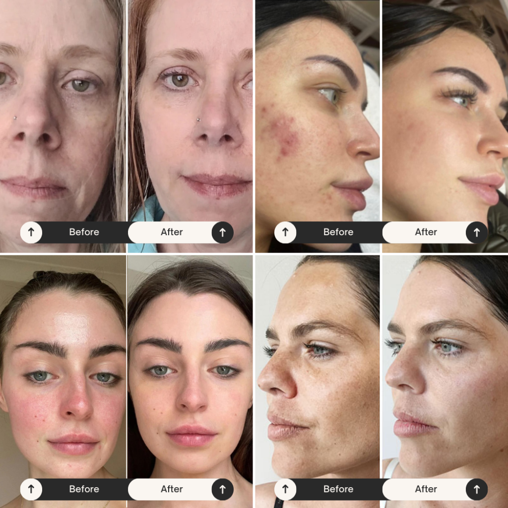 Before and after photos of users showing significant improvements in skin tone and texture after using the RLB Salon-Grade LED Light Therapy System