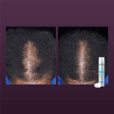 Women's Rogaine 5% Minoxidil Foam for Hair Thinning and Loss, Topical Treatment for Hair Regrowth 2.11oz - New