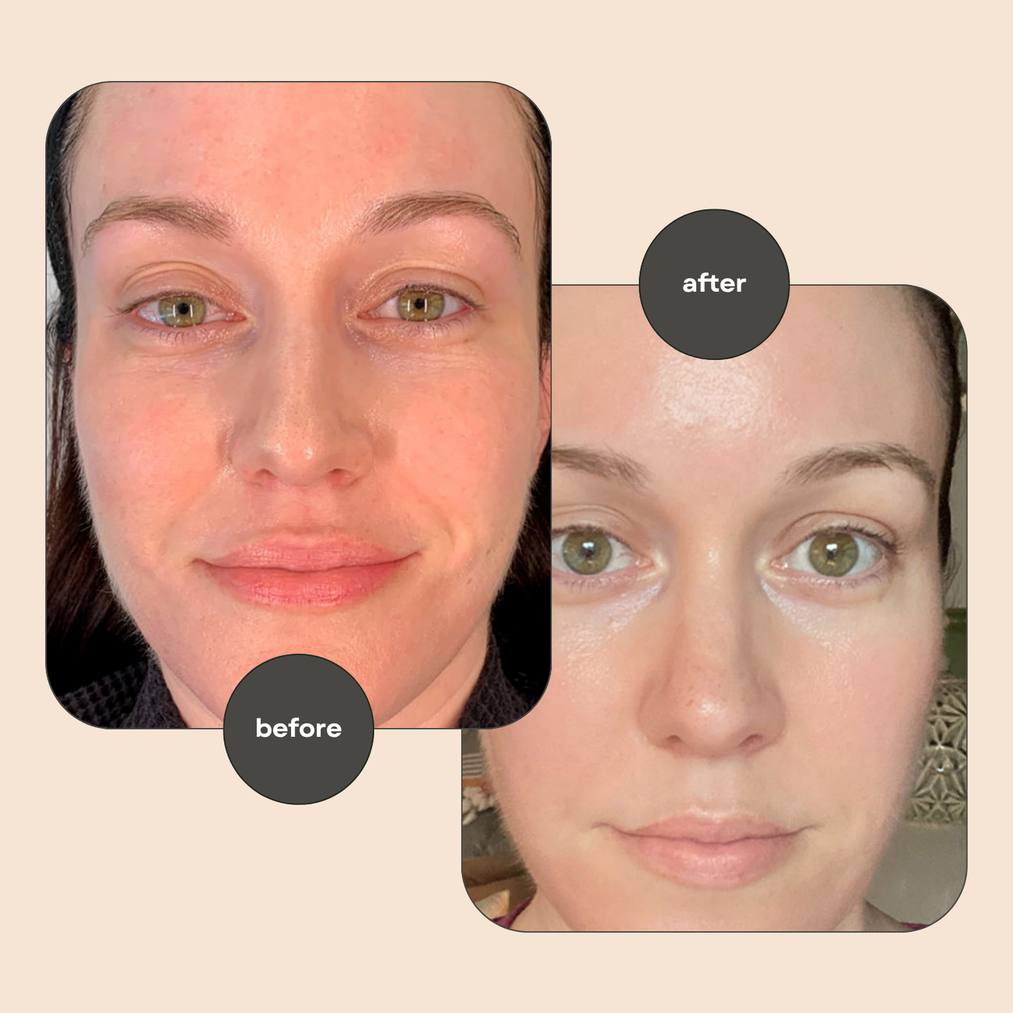 Before and after comparison of a person's face with visible skin improvement.