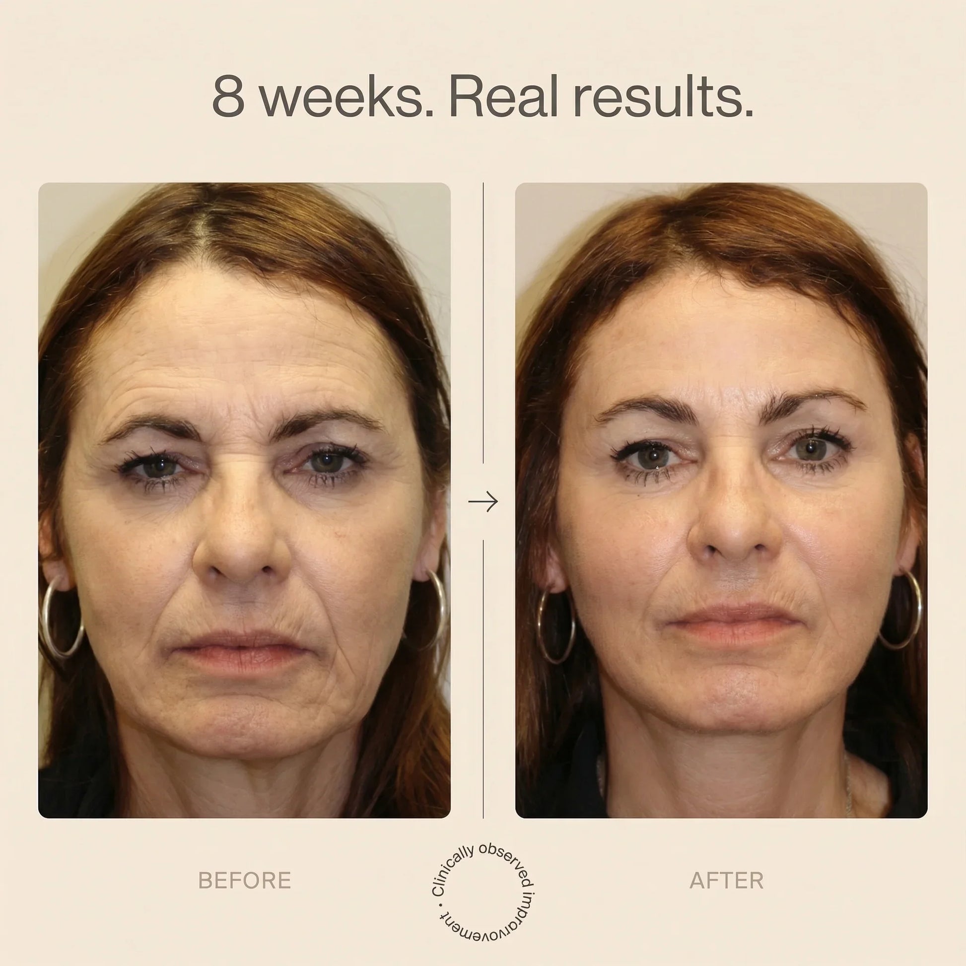 Red light therapy before and after results on woman's face, improved skin after 8 weeks