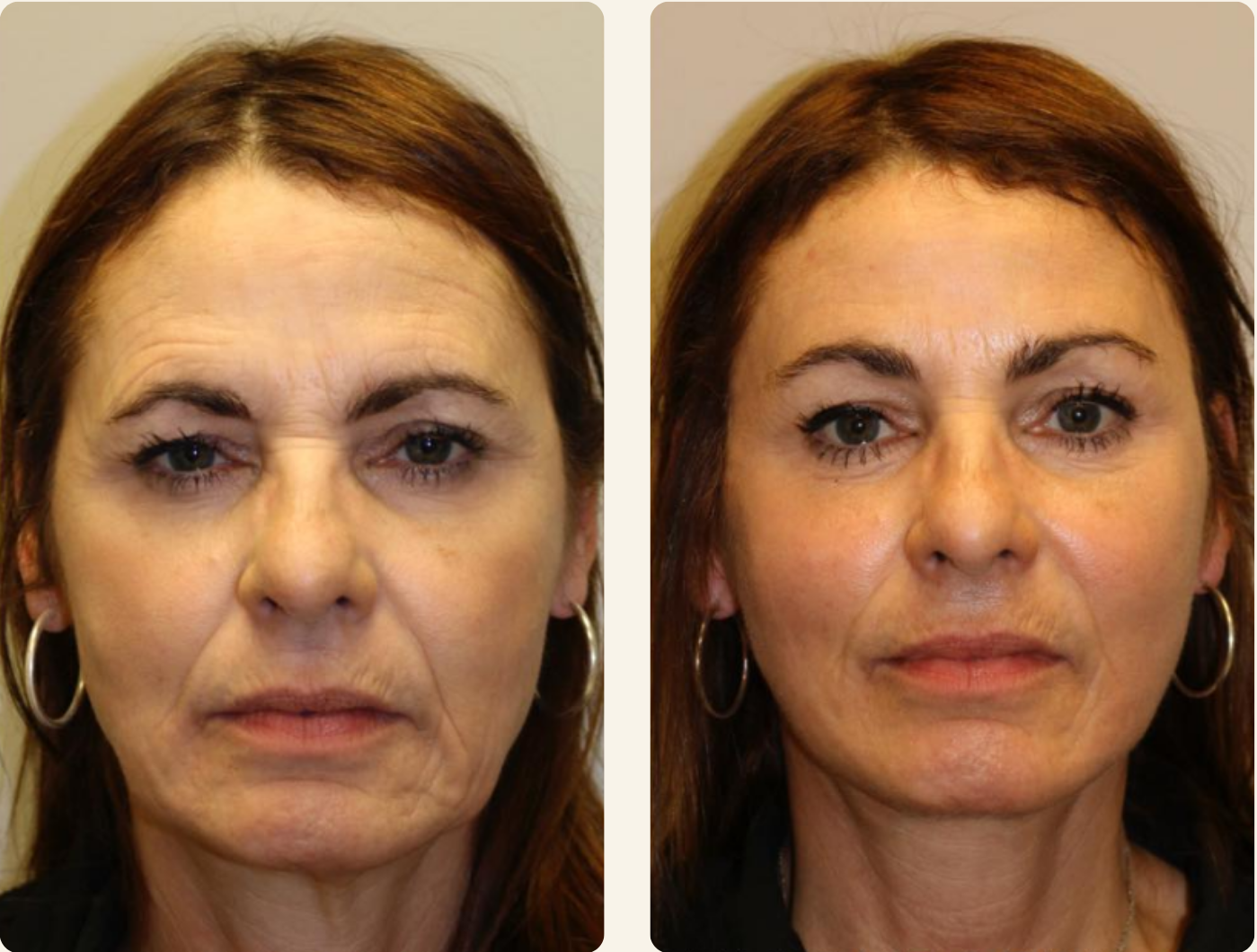 Before and after comparison of a woman's face with text indicating 8 weeks of use and positive results.