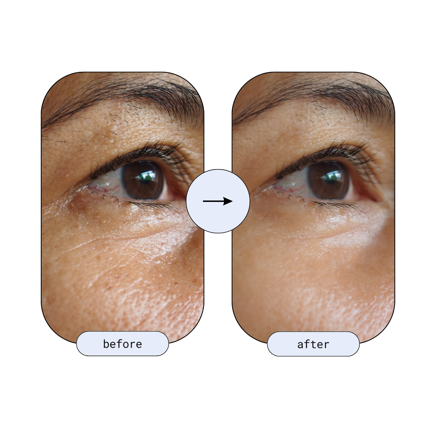 Before and after close-up of eye wrinkles showing significant reduction after using the RLB Anti-Aging LED Mask.