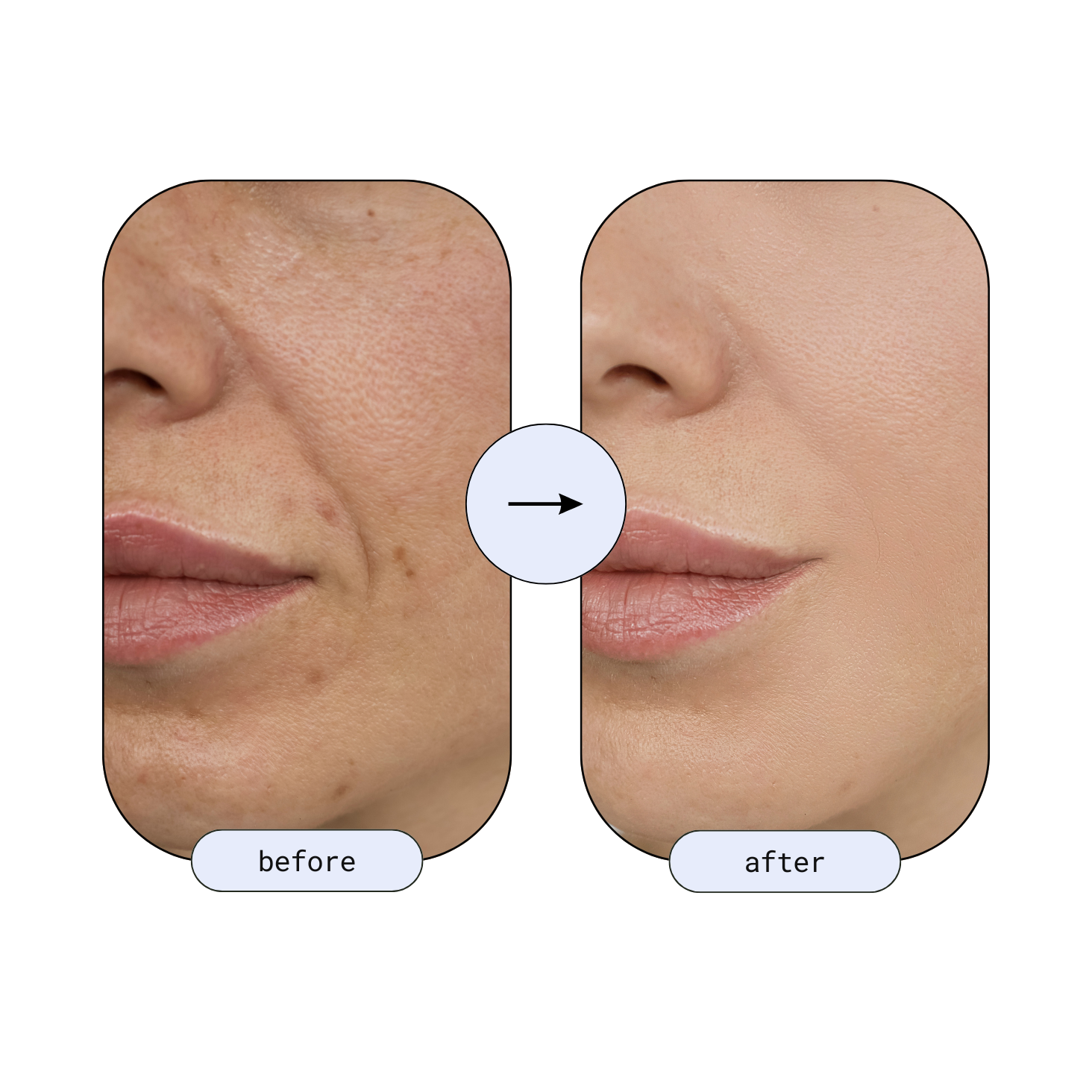 Before and after images showing smoother cheek skin and improved texture after using the RLB Anti-Aging LED Mask.