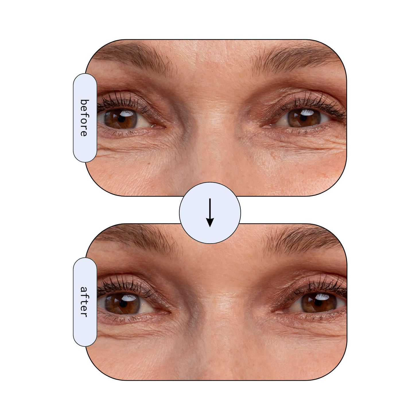 Before and after close-up of reduced crow's feet around the eyes after using the RLB Anti-Aging LED Mask.