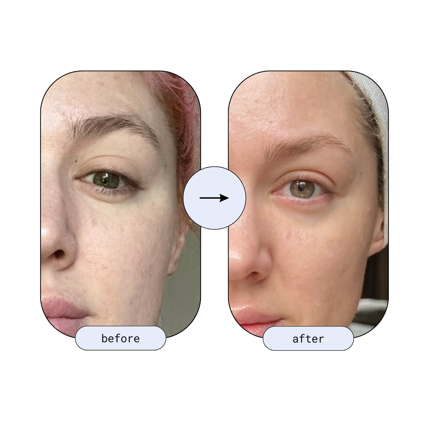 Before and after results of a young woman using the RLB Anti-Aging LED Mask showing smoother skin and improved complexion.